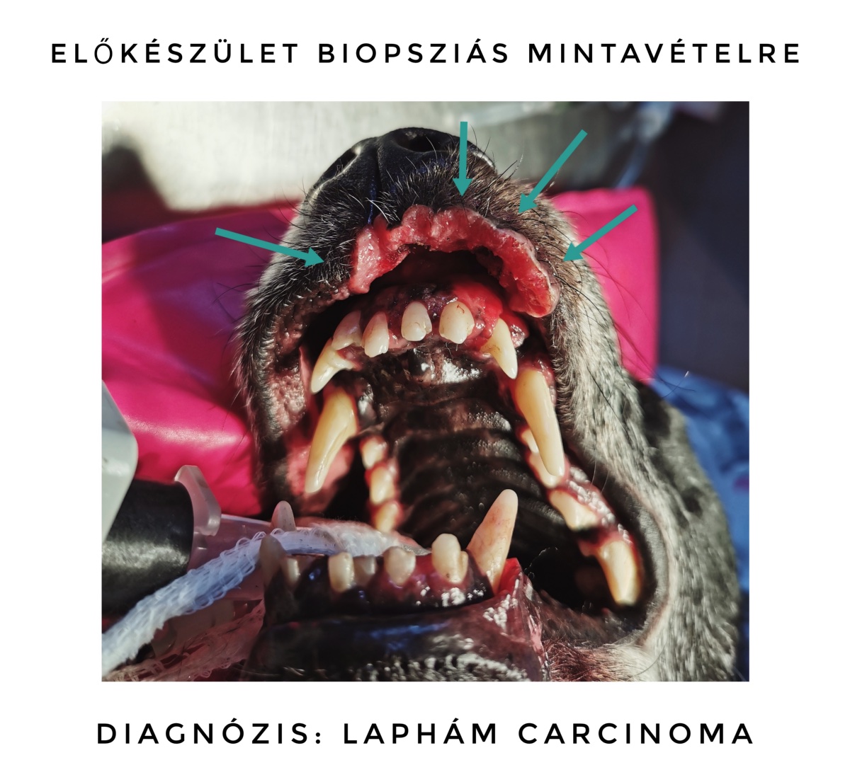 laphám carcinoma
