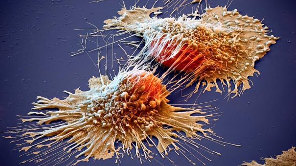 Daganatos sejt elektromikroszkópos felvétele