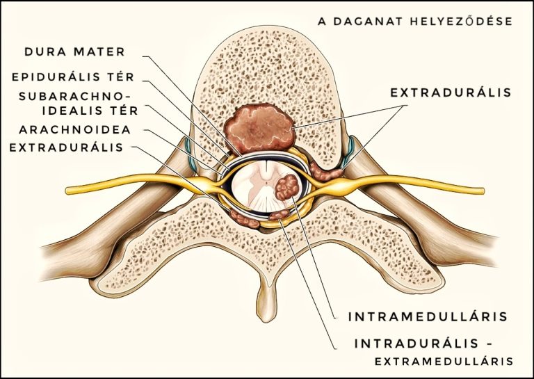 Gerinc keresztmetszet - daganatok helyezkedése