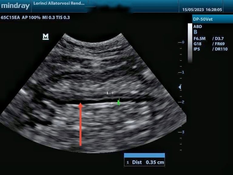 gyulladás miatt megvastagodott izomréteg