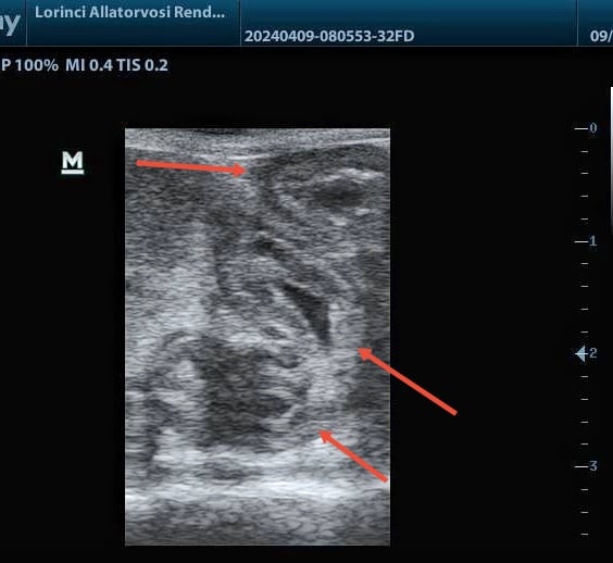 gyűrűszerűen megvastagodott vékonygbél