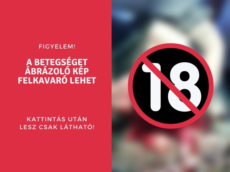 megrepedt hemangiosarcoma műtéti eltávolítása