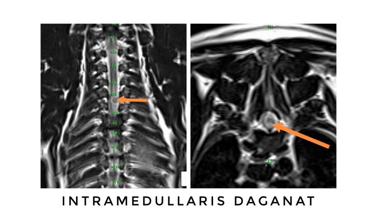 Intramedullaris daganat MRI felvétele