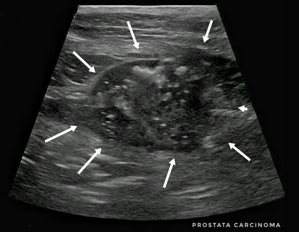 prostata carcinoma