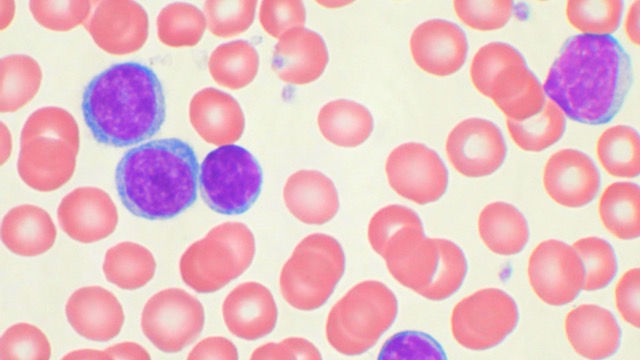 Akut limfoblasztos leukémia mikroszkópos képe