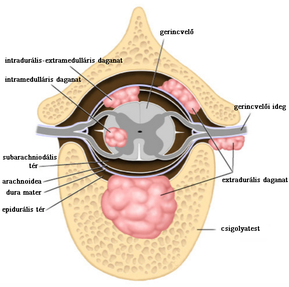 gerincvelő tumor