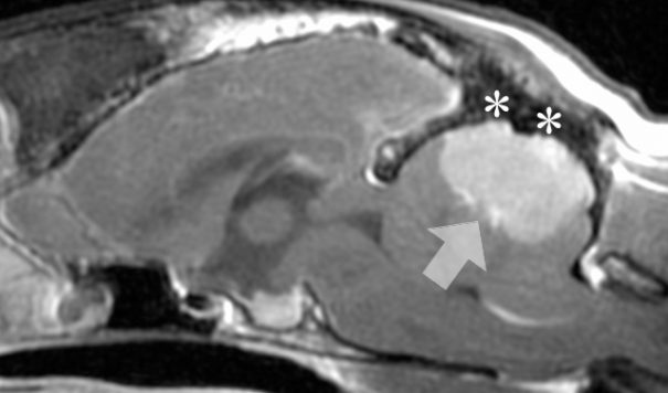 meningioma