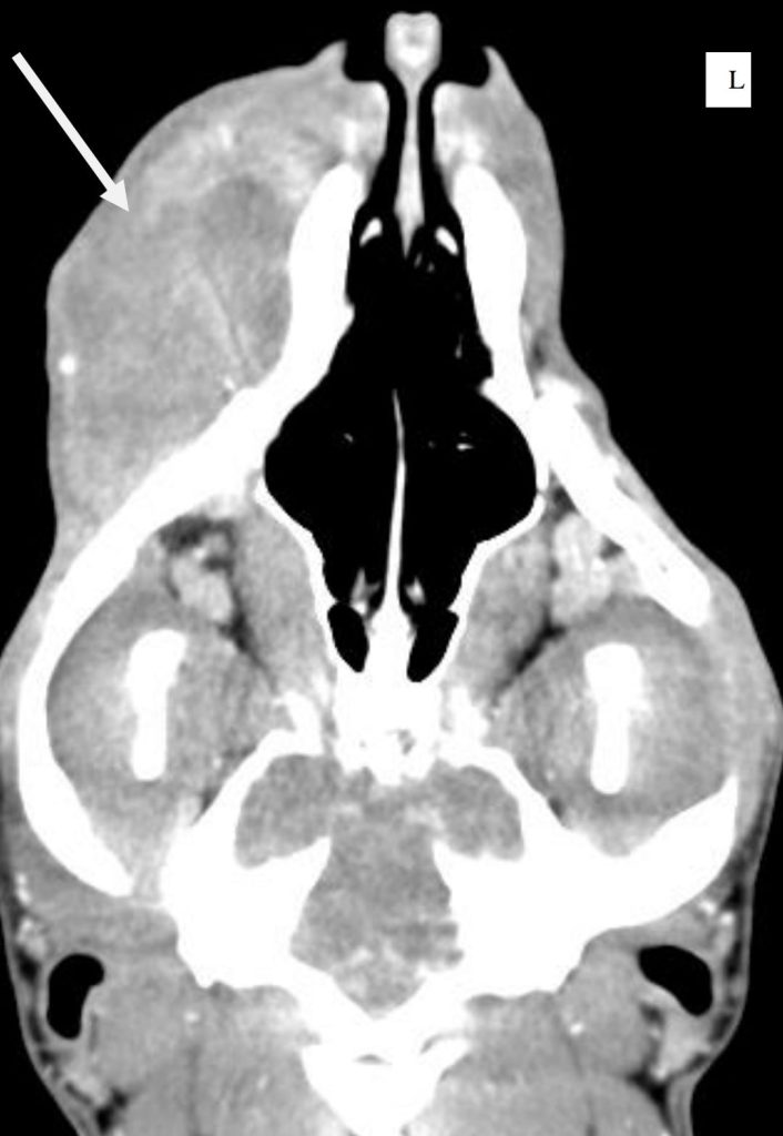 fibrosarcoma CT felvétele kutya állcsontjánál