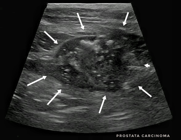 prosztata daganat (prostata carcinoma) ultrahang képe